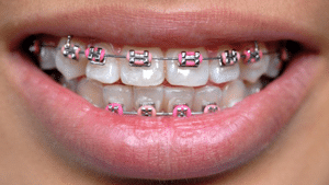 Would Ceramic braces work for you?